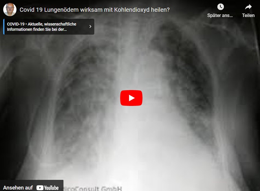Covid 19 Lungenödem wirksam mit Kohlendioxyd heilen?